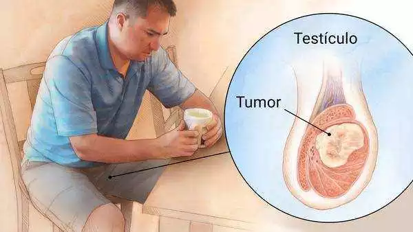tumor testículo